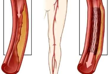 Viêm tắc động mạch chi - bệnh do lối sống