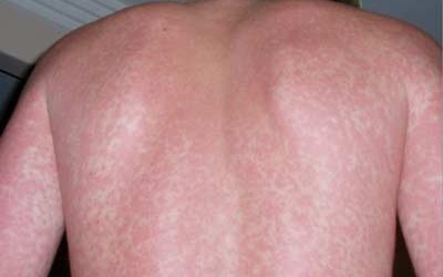 Sốt xuất huyết có nguy cơ lan rộng