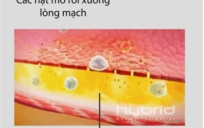 Tại sao 'chăm' uống thuốc vẫn bị tai biến?