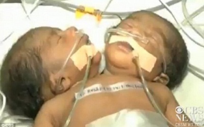 Ấn Độ: Ca sinh đôi dính liền một thân, hai đầu hy hữu