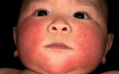 Cảnh giác với triệu chứng dị ứng đạm sữa bò ở trẻ