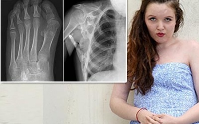 Nỗi buồn 'Thạch nữ' và hội chứng FOP