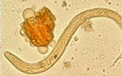 Giun 15 cm sống ký sinh trong não