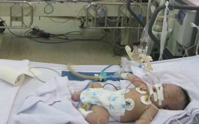 Uốn ván sơ sinh tấn công trẻ vùng sâu vùng xa