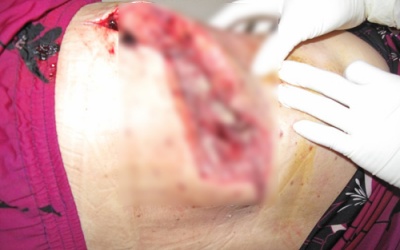 Nguy kịch do nhiễm trùng sau 'cắt lễ'