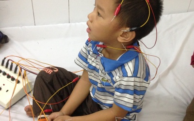 Châm cứu chữa tự kỷ