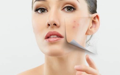 Tránh mụn chẳng xấu mặt nào...