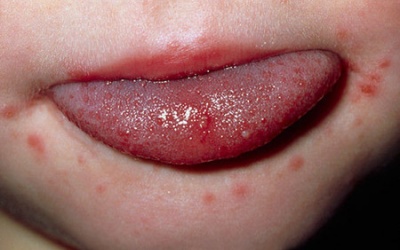 Bệnh tay chân miệng gia tăng tại Hà Nội