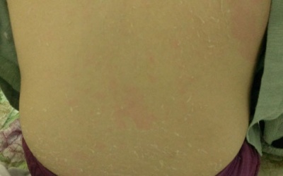 Bị lột da loang lổ vì tắm trắng tại nhà