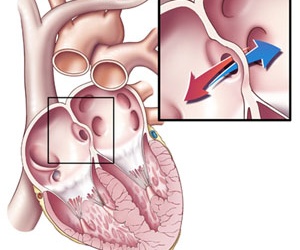 TPCN nào hỗ trợ điều trị bệnh tim bẩm sinh?