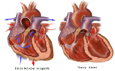 Trung Quốc: 10 giây lại có người chết vì tim mạch