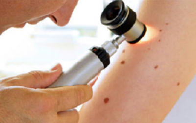 Những dấu hiệu nguy cơ của u hắc tố