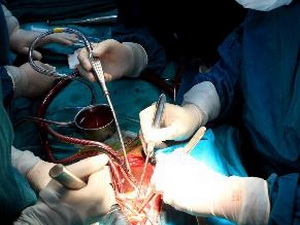 Cứu sống bệnh nhân phồng lóc động mạch chủ nặng