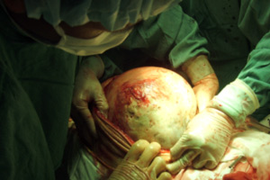 Giảm 23 kg chỉ sau một cuộc phẫu thuật!