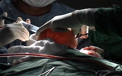 Phẫu thuật cắt bỏ đầu thừa cho em bé mắc bệnh lạ