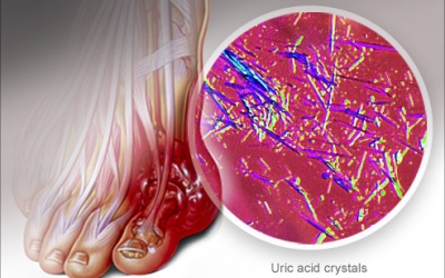 Bệnh về khớp - càng chần chừ, càng khó chữa
