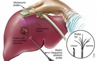 Trị ung thư gan bằng sóng cao tần