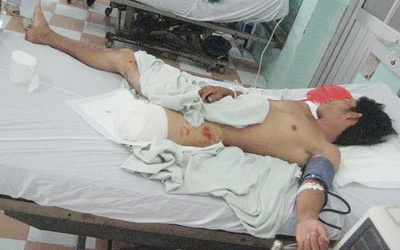 Cứu bệnh nhân bị xay nát chân và bộ phận sinh dục