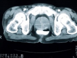 Phát hiện sớm tế bào ung thư bằng âm thanh