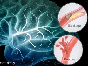 Vắc xin phòng cúm có thể giúp giảm nguy cơ đột quỵ