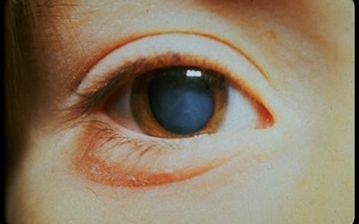 44 bệnh nhân nghèo bị đục thủy tinh thể được điều trị miễn phí