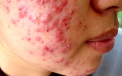 Những hình ảnh ghê rợn từ lột da tắm trắng