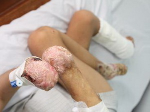 Phát hiện bệnh gây hoại tử tứ chi tại TP Hồ Chí Minh