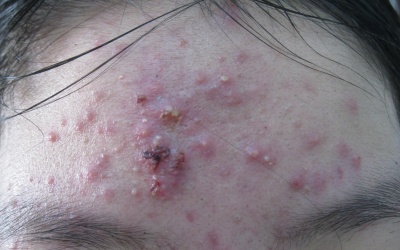 Hơn 96% người bị trứng cá nặng do bôi corticoid