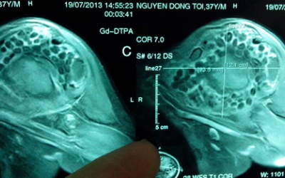 Mổ nội soi lấy gần 300 viên sỏi trong khớp vai