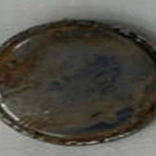 Lấy cục pin trong thực quản bệnh nhi 10 tháng tuổi