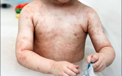 40% trẻ nhỏ có nguy cơ dị ứng thức ăn