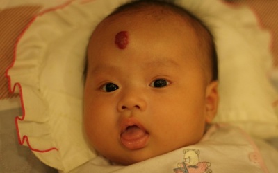 U máu, lành nhưng mệt