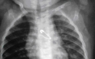 Bé 6 tháng tuổi nuốt kim băng 2 cm