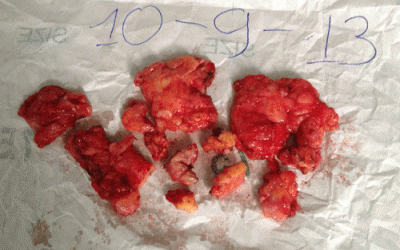 Hại thân vì bơm ngực bằng 'mỡ nhân tạo'