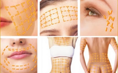 Căng da bằng lưới chỉ vàng 24k - đẹp hay độc?