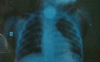 Bé trai bị mắc đồng xu trong thực quản hơn 1 năm