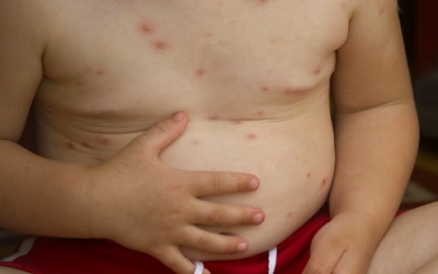 Các bệnh thường gặp ở trẻ