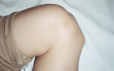 Viêm khớp ở trẻ em: Phát hiện muộn, dễ gây tàn phế