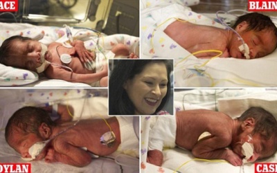 Song sinh - kết nối kỳ diệu và những chuyện lạ có thật