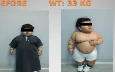 Bé 2 tuổi phải giảm cân bằng phẫu thuật cắt dạ dày