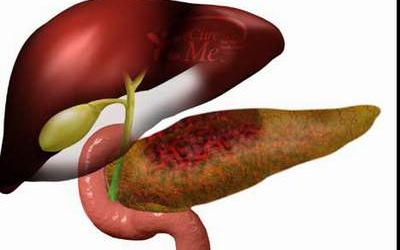 Dấu hiệu bất thường cảnh báo ung thư tuyến tụy