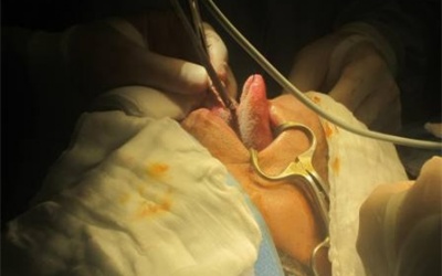 Tái tạo lưỡi bằng vạt da cho bệnh nhân ung thư