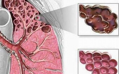 Bệnh khí phế thũng ở người cao tuổi