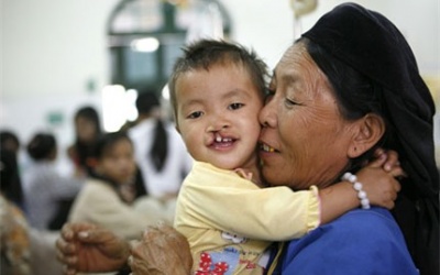 Chăm sóc trẻ sứt môi - hở vòm sau phẫu thuật