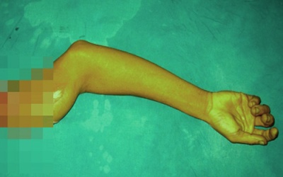 Kỳ công nối cánh tay đứt lìa sát nách