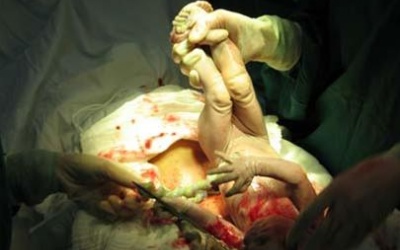 Mẹ bị cắt tử cung, con tử vong sau mổ