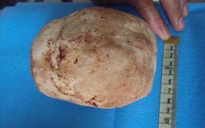 An Giang: Lấy thành công viên sỏi gần 1kg ra khỏi bàng quang