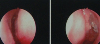 Điều trị viêm xoang, bị cắt… polyps