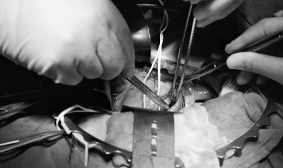 Ghép thận từ bé 5 tuần tuổi cho người lớn