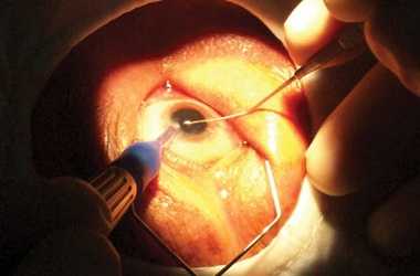 Đà Nẵng: Hỗ trợ phẫu thuật mắt cho trẻ em